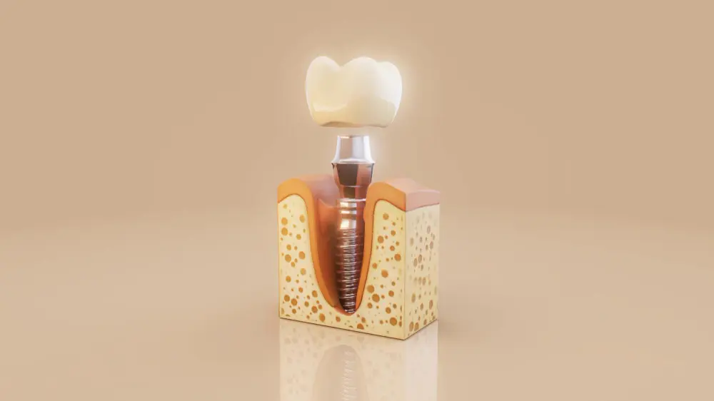 Dental Implants